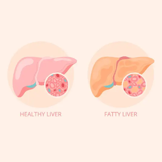 Fatty-Liver-Causes